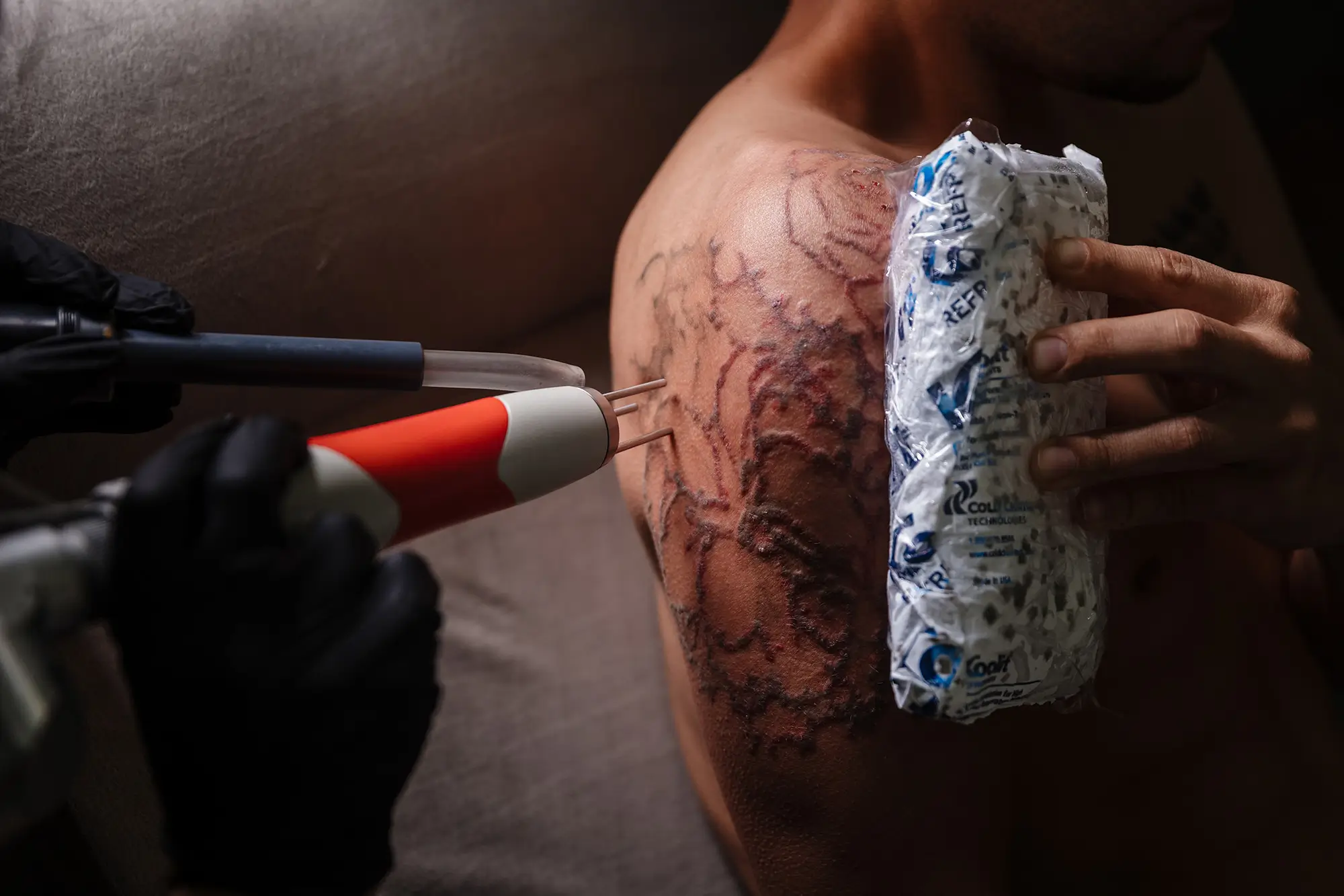 Shoulder tattoo immediately after a removal pass, with a cold pack held against the treated skin