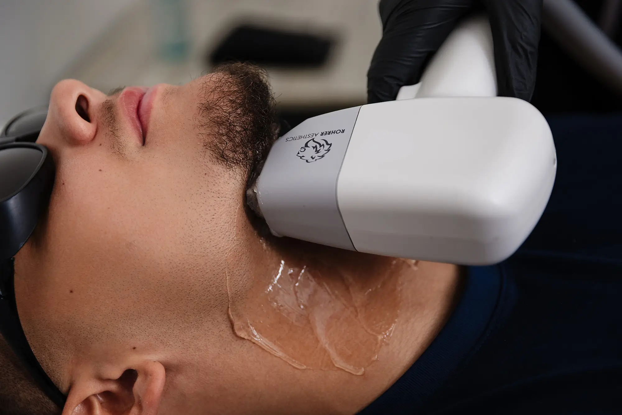 Close-up of a laser hair removal handpiece passing along a man's beard line at Wichita Laser Clinic