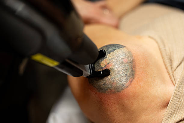 Close-up of a Q-switched laser handpiece with cooling tip treating a faded shoulder tattoo at Wichita Laser Clinic
