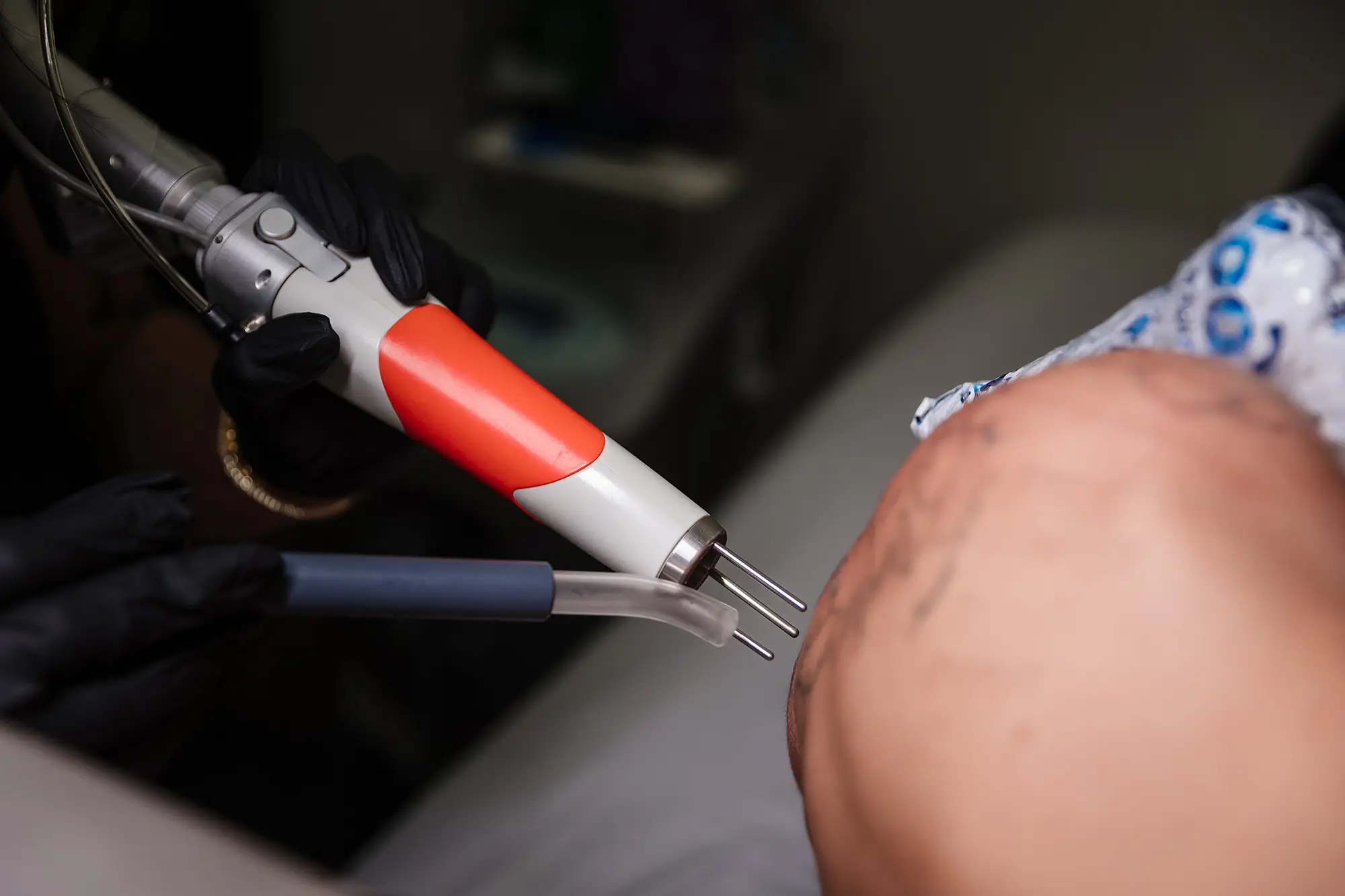 Close-up of the Q-switched Nd:YAG handpiece and cooling tip positioned against a tattooed arm